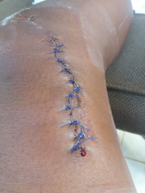 Nurse Injured on the Job Apr 2018 pt1